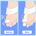 Bunion Corrector for Women Men Hallux Valgus Brace Splint Pads Big Toe Separators Straightener (White-1Pack)