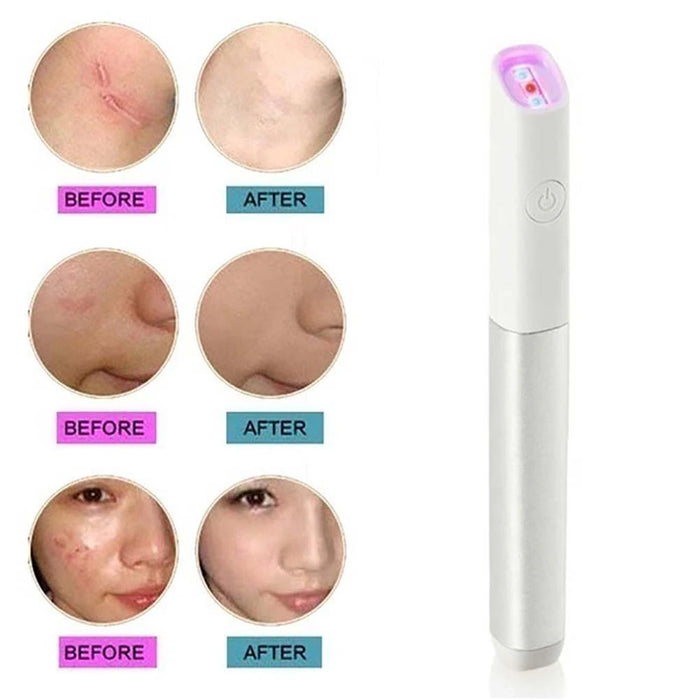 Anti-Varicose Veins Removal Pen Anti-Inflammation Acne Scar Wrinkle Removal Treatment Pen